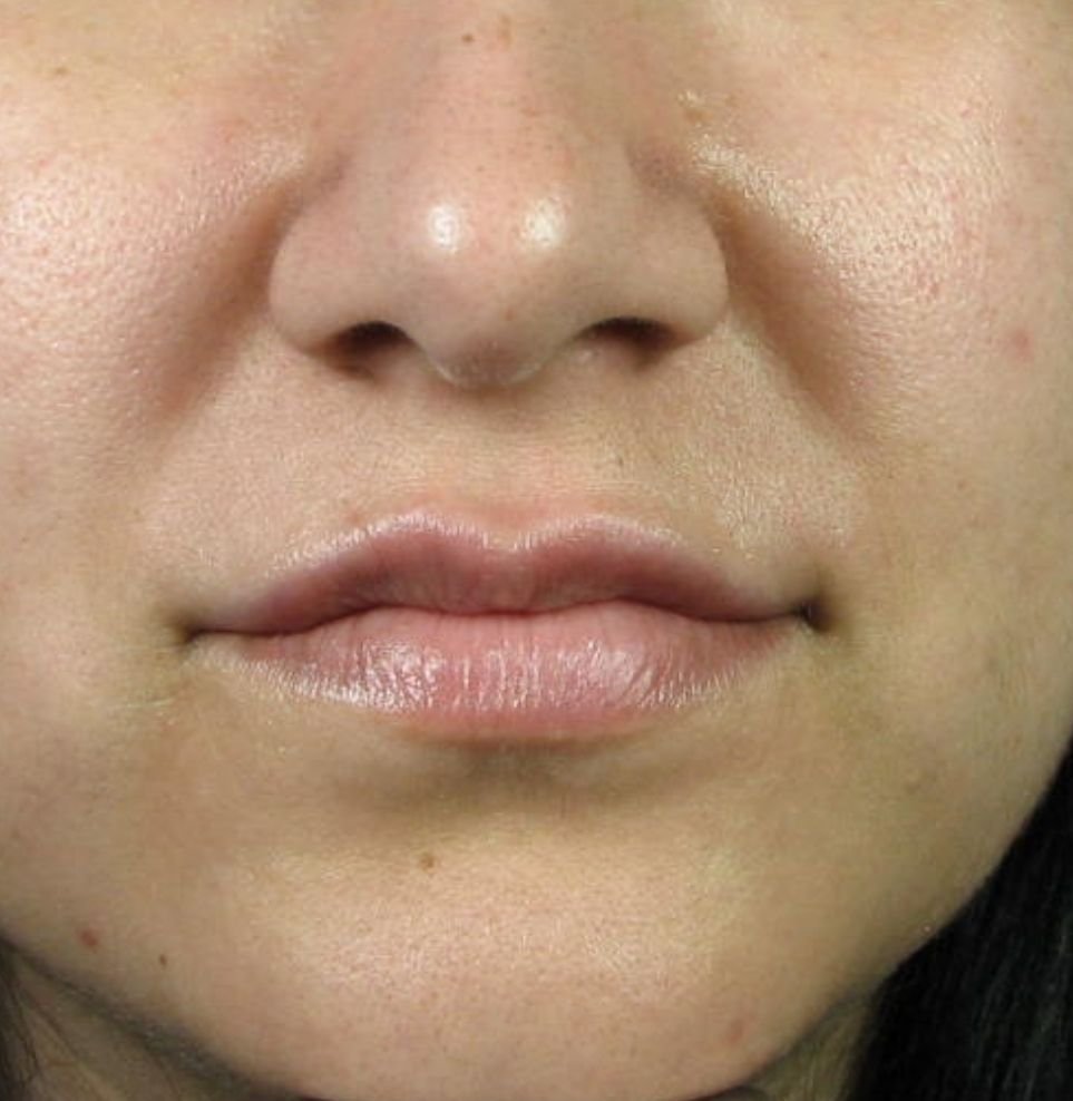 lip fillers london treatment after