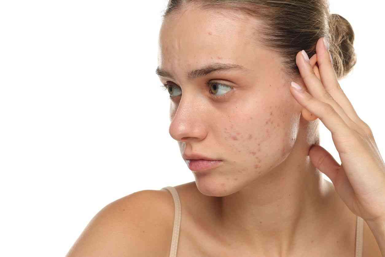 woman with acne scars.jpg