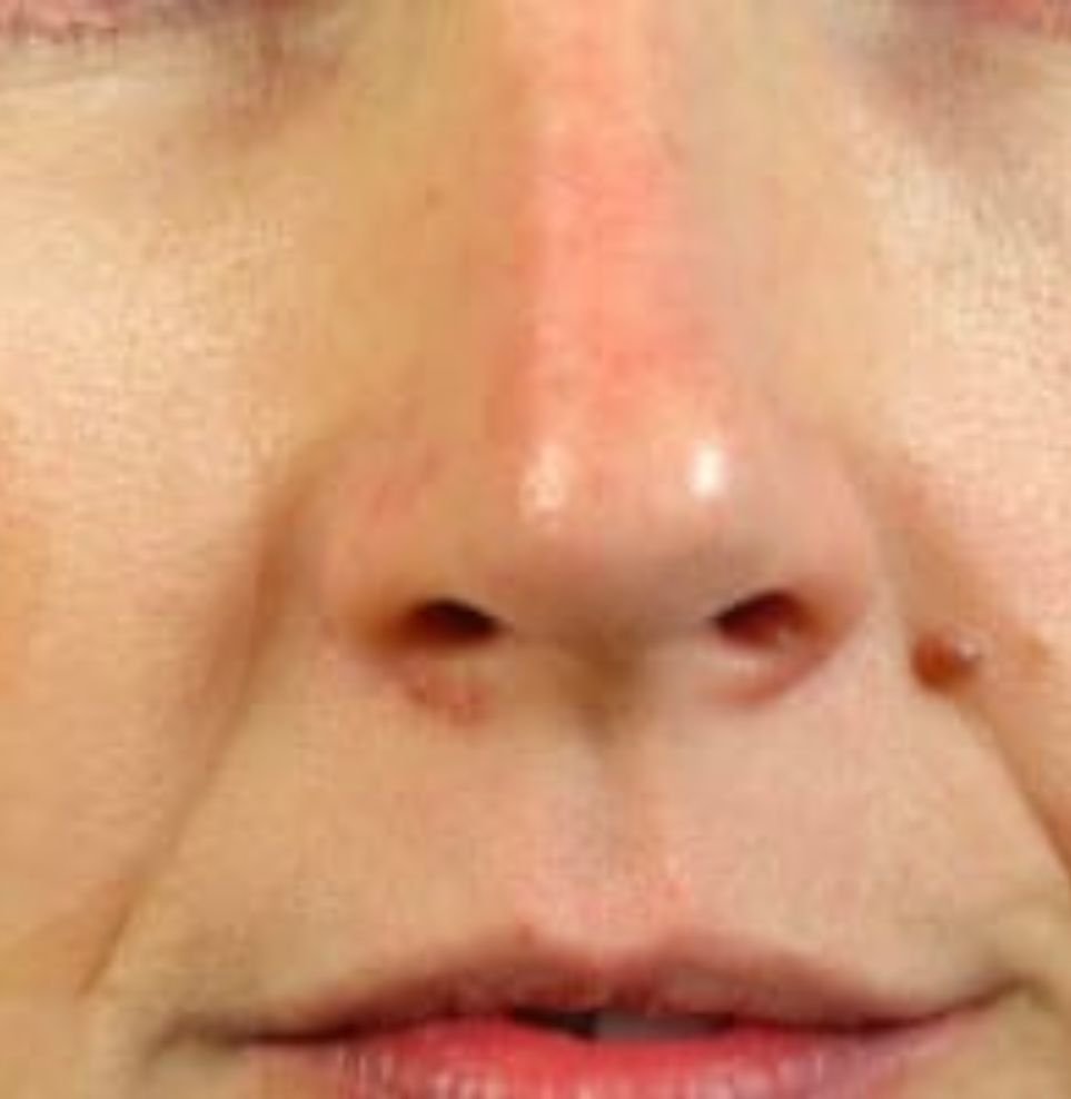 nose filler treatment after