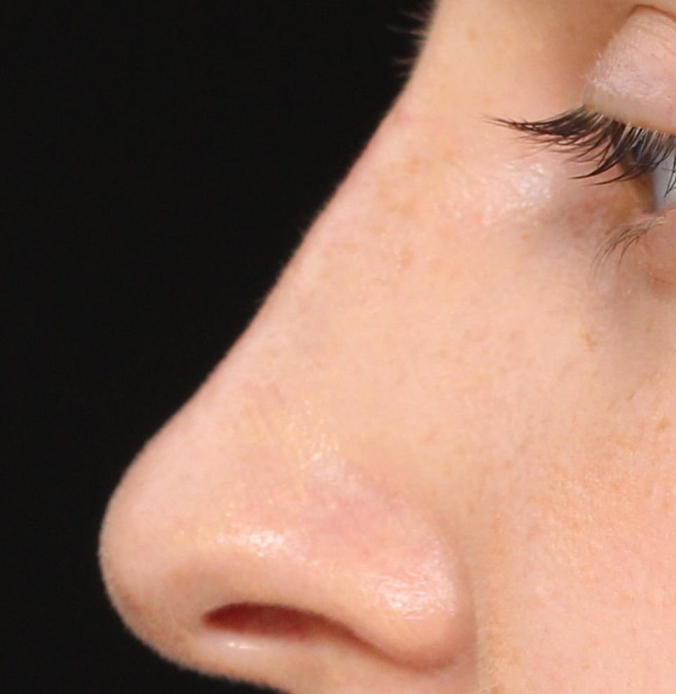nose filler treatment after