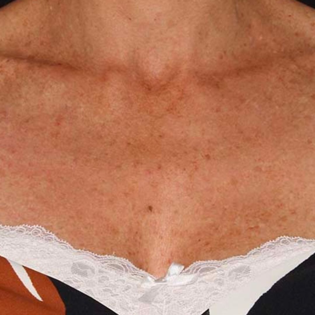 IPL treatment after