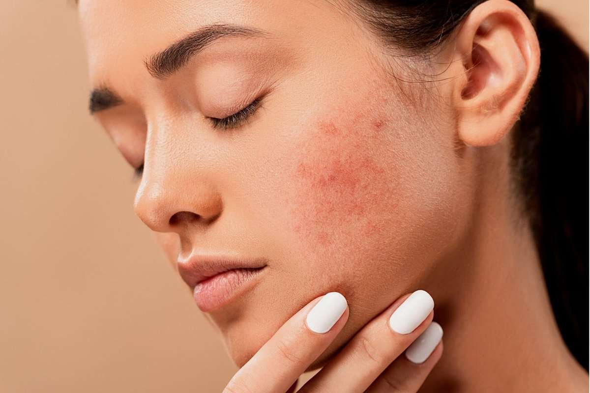adult acne treatment london