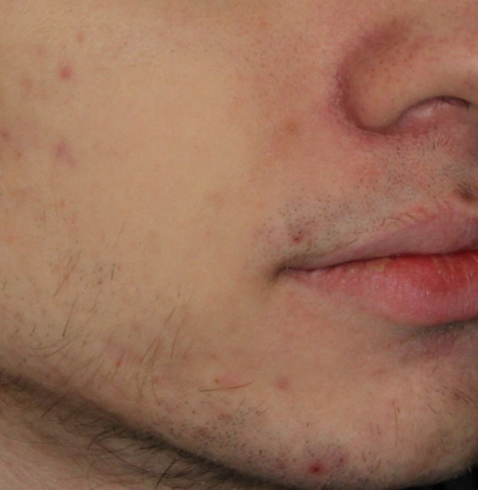 acne results after