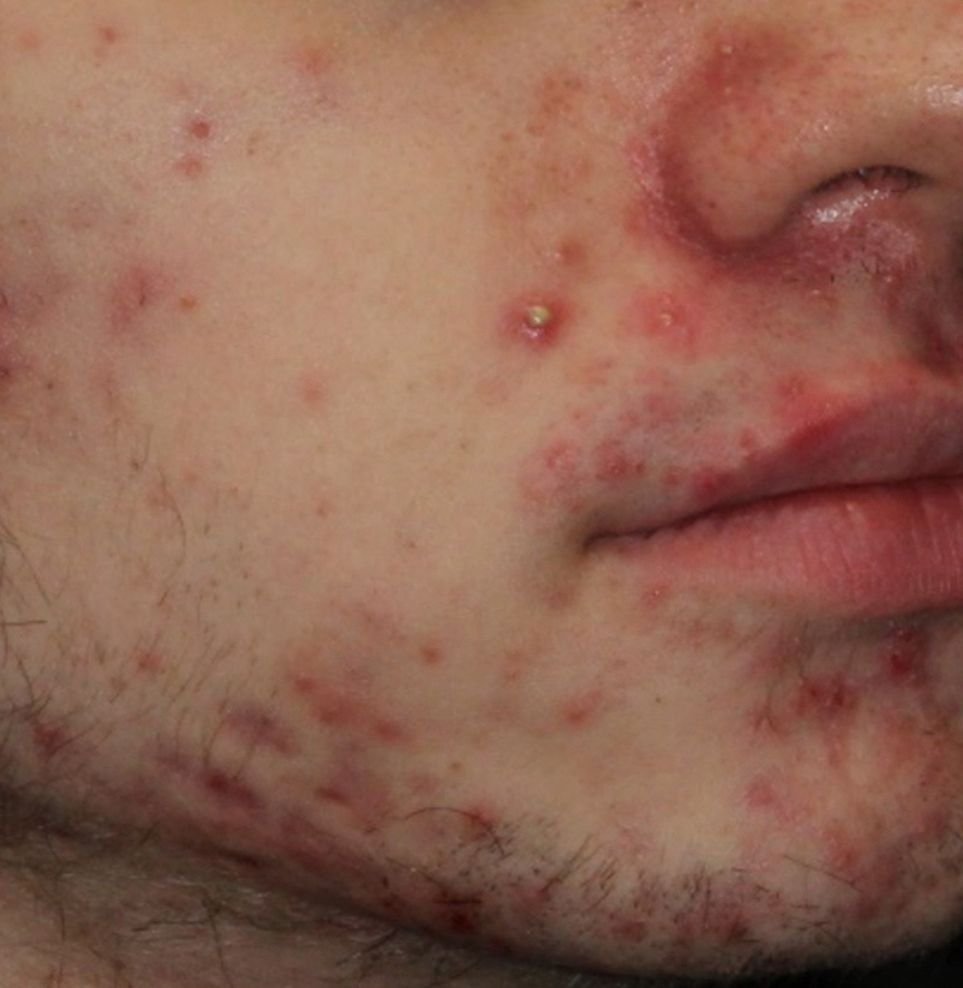 acne results before