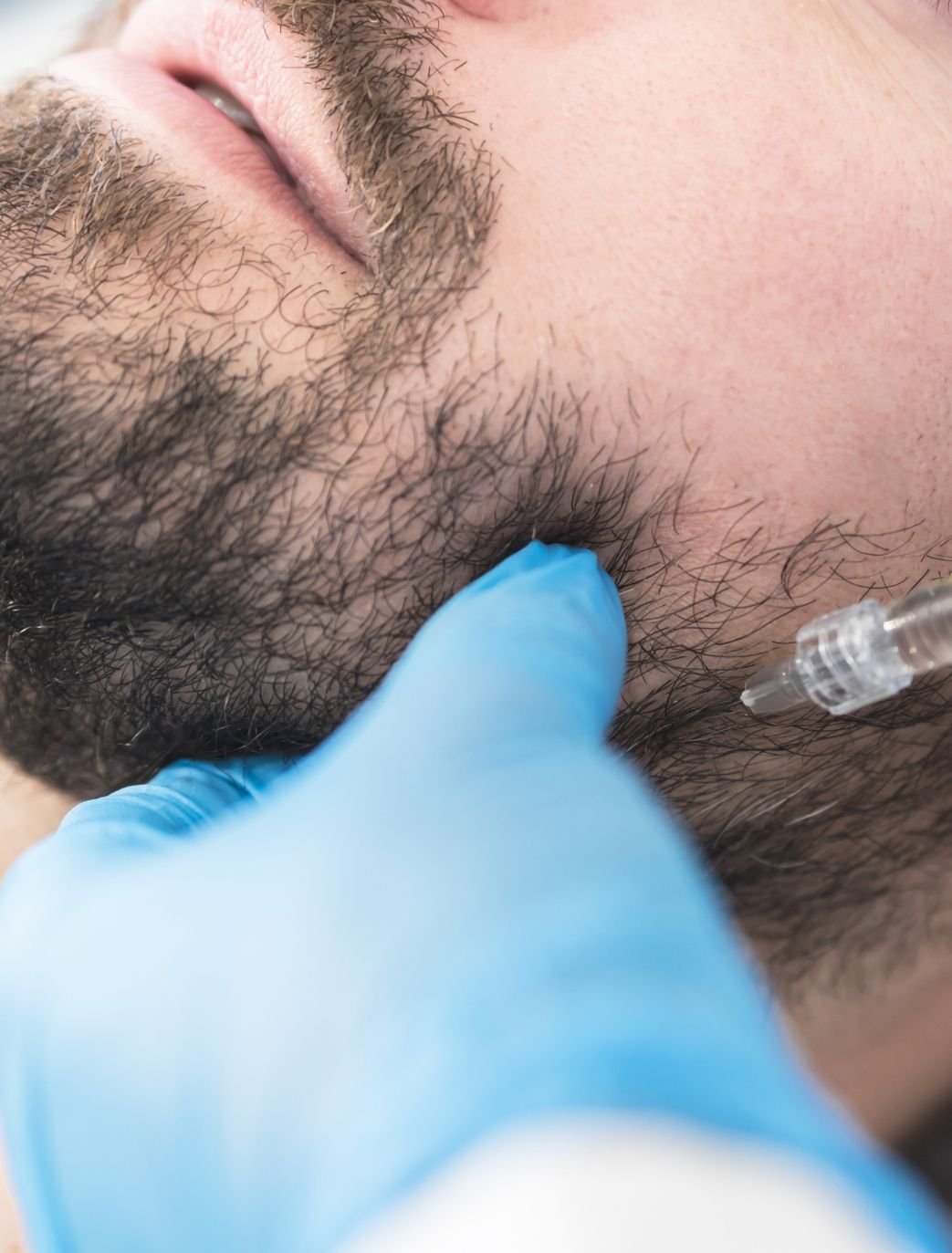chin filler men london