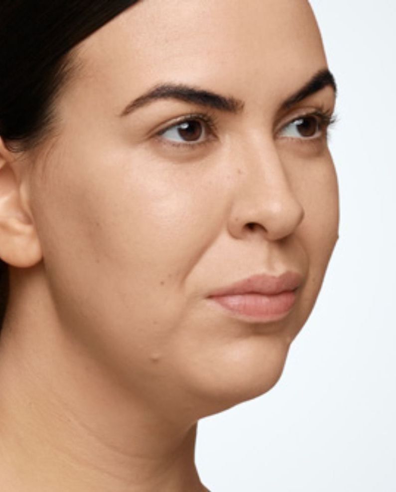 chin fillers results