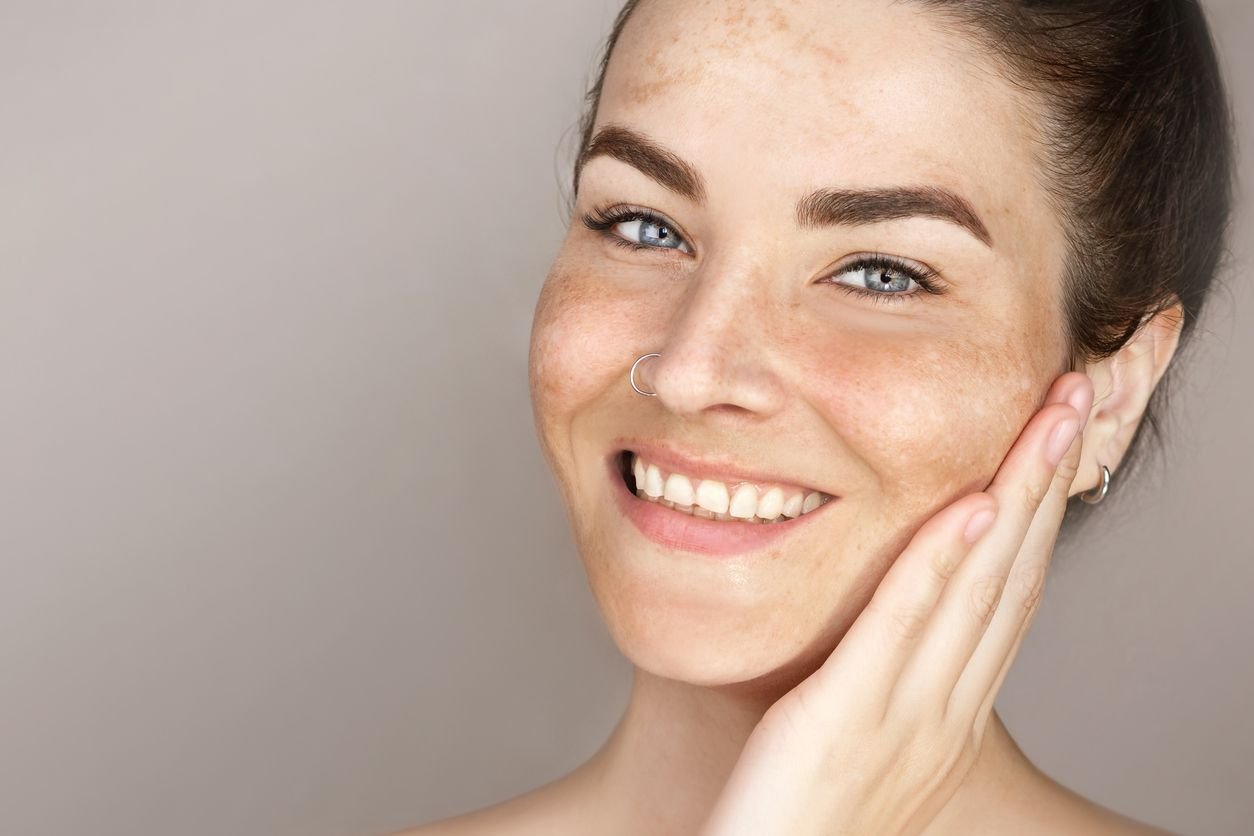 face pigmentation