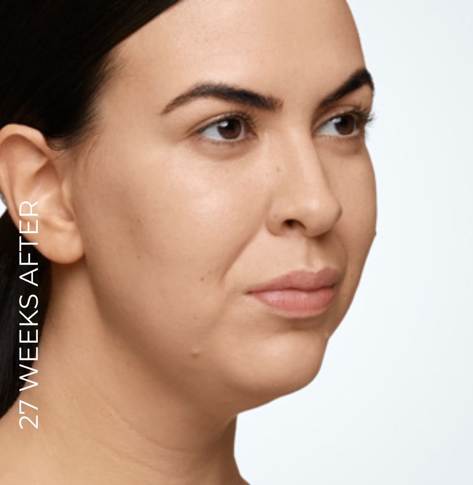 fat reduction face