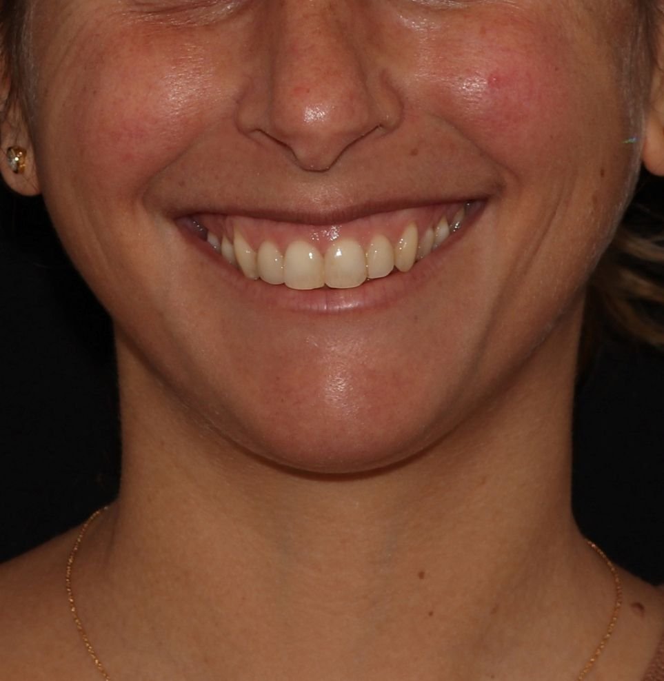 gummy smile treatment