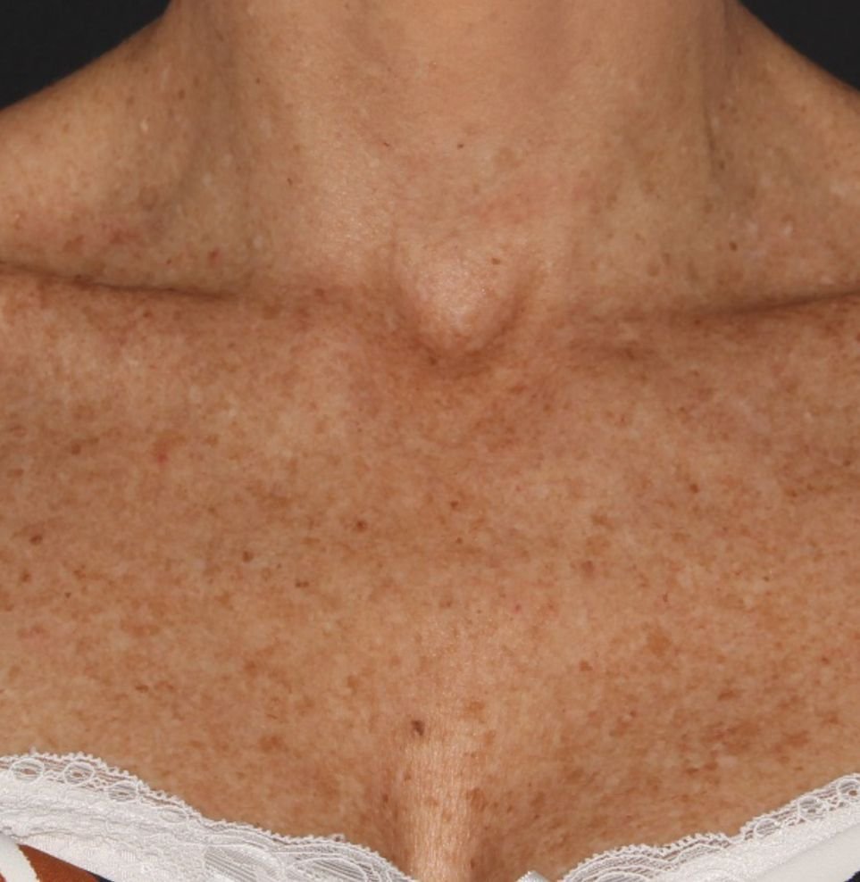 m22 with ipl before