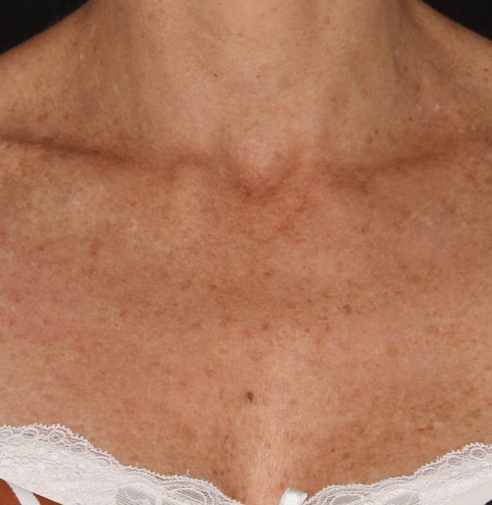 m22 with ipl after
