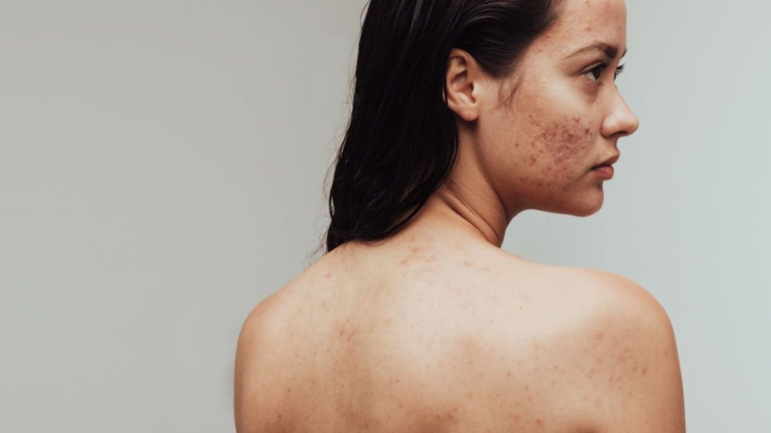 novojet facial london.jpg