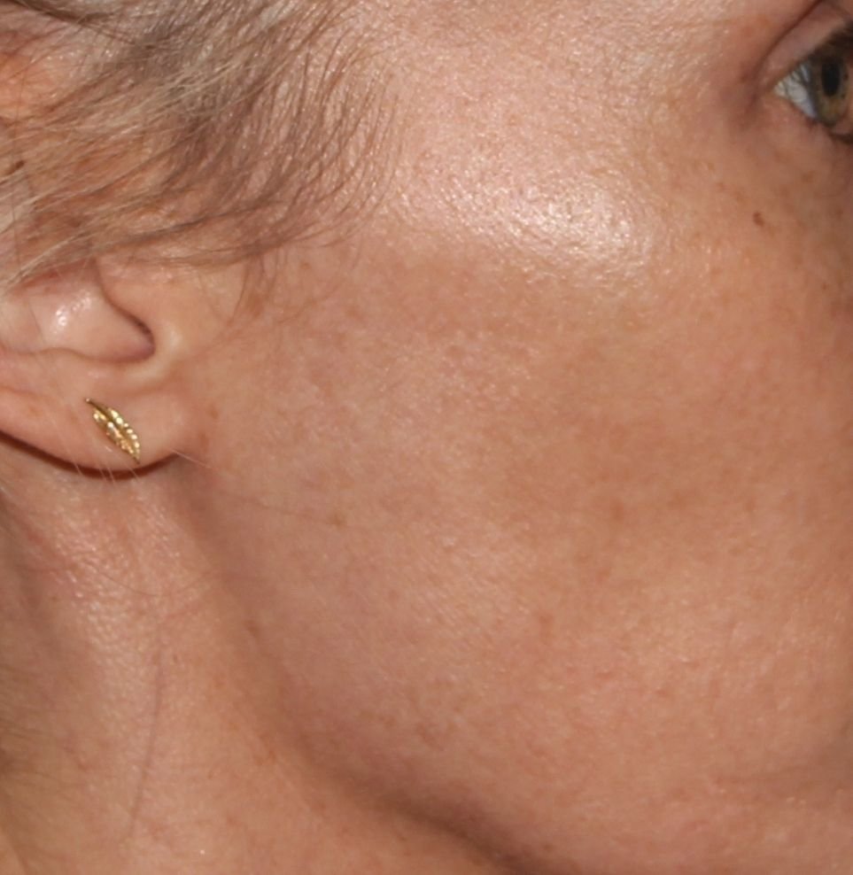 pigmentation after M22