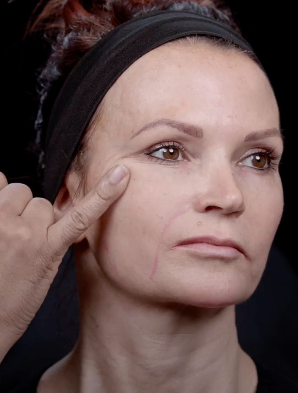 skin tightening london