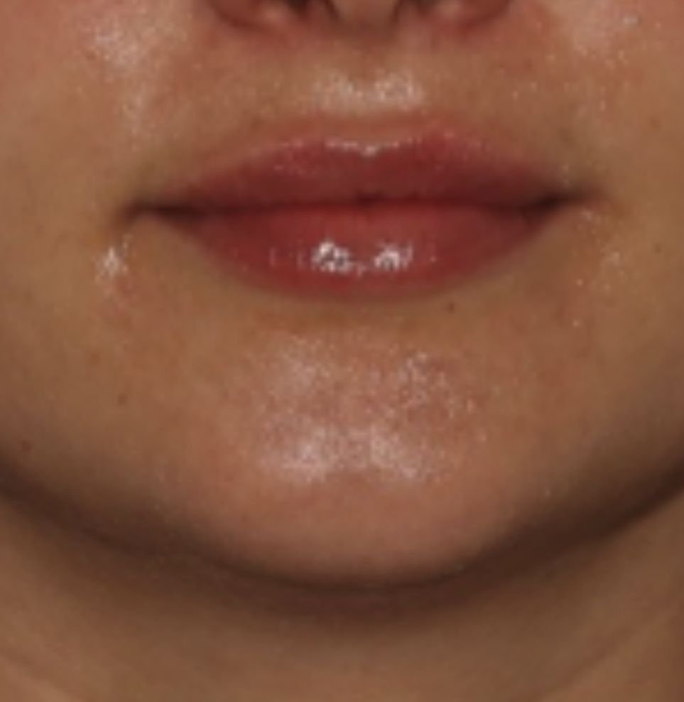lip fillers london after treatment