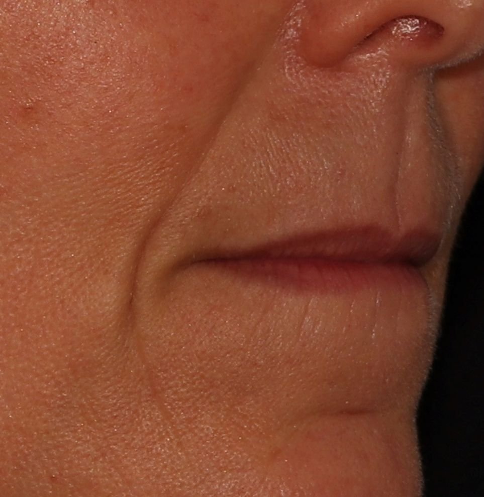 phi lip filler treatment before