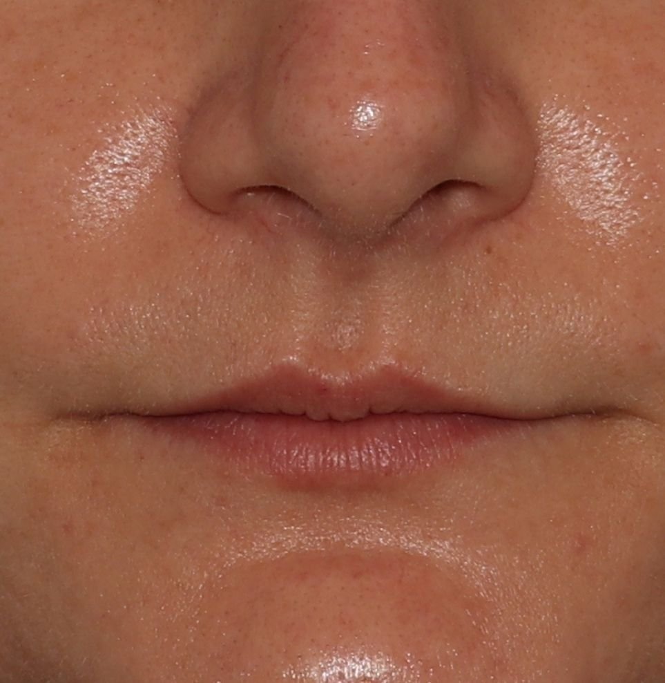 lip fillers treatment before