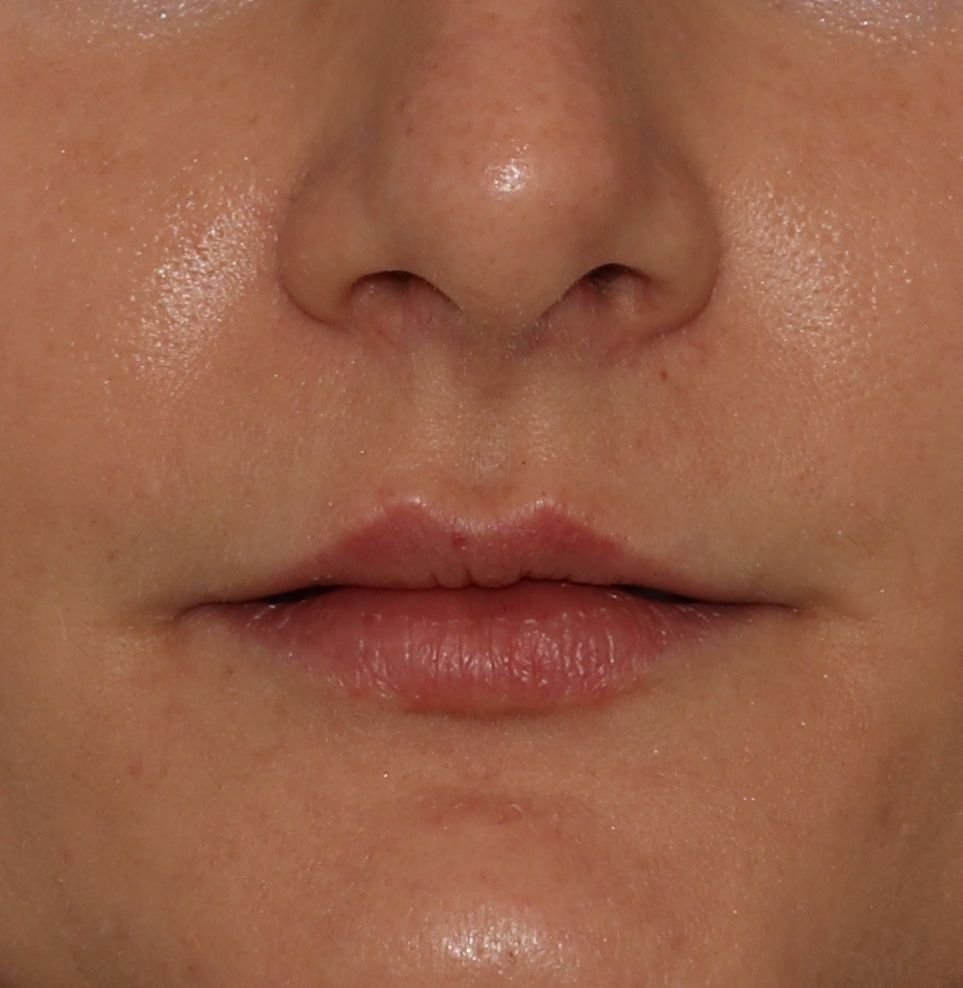 lip fillers treatment after