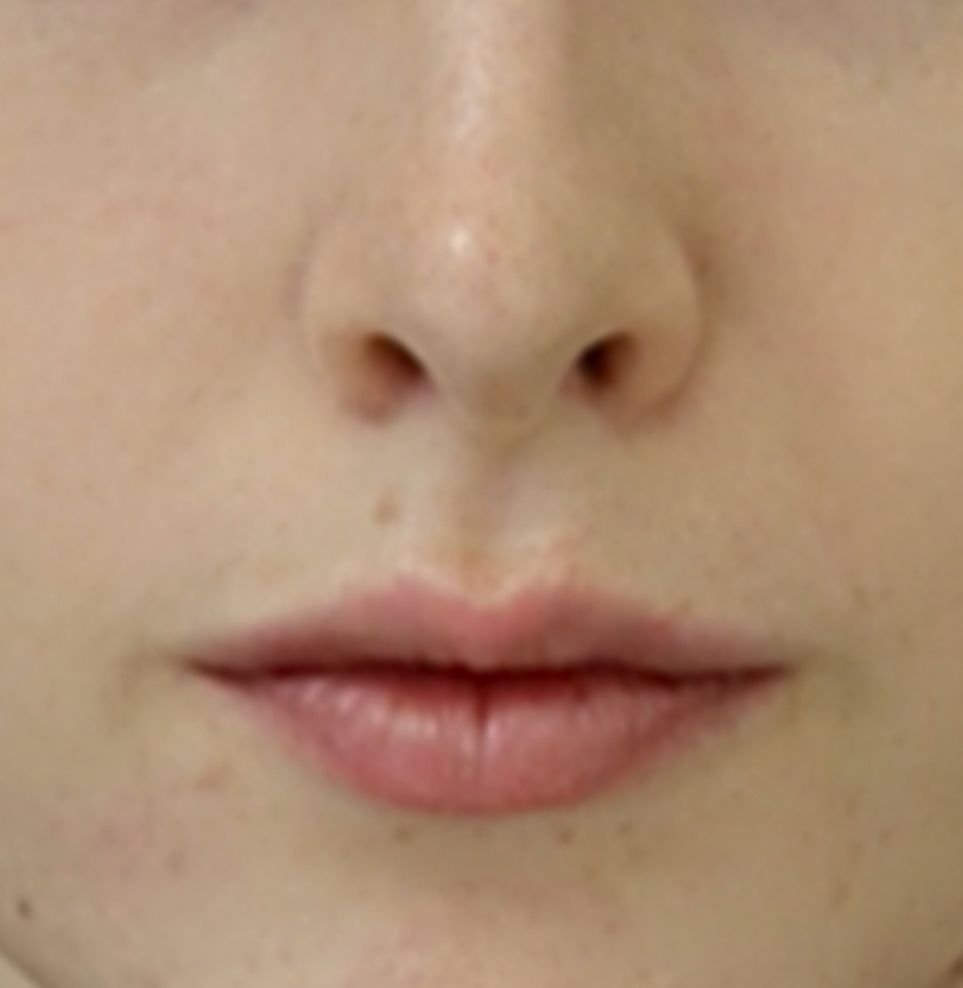 london lip fillers treatment after