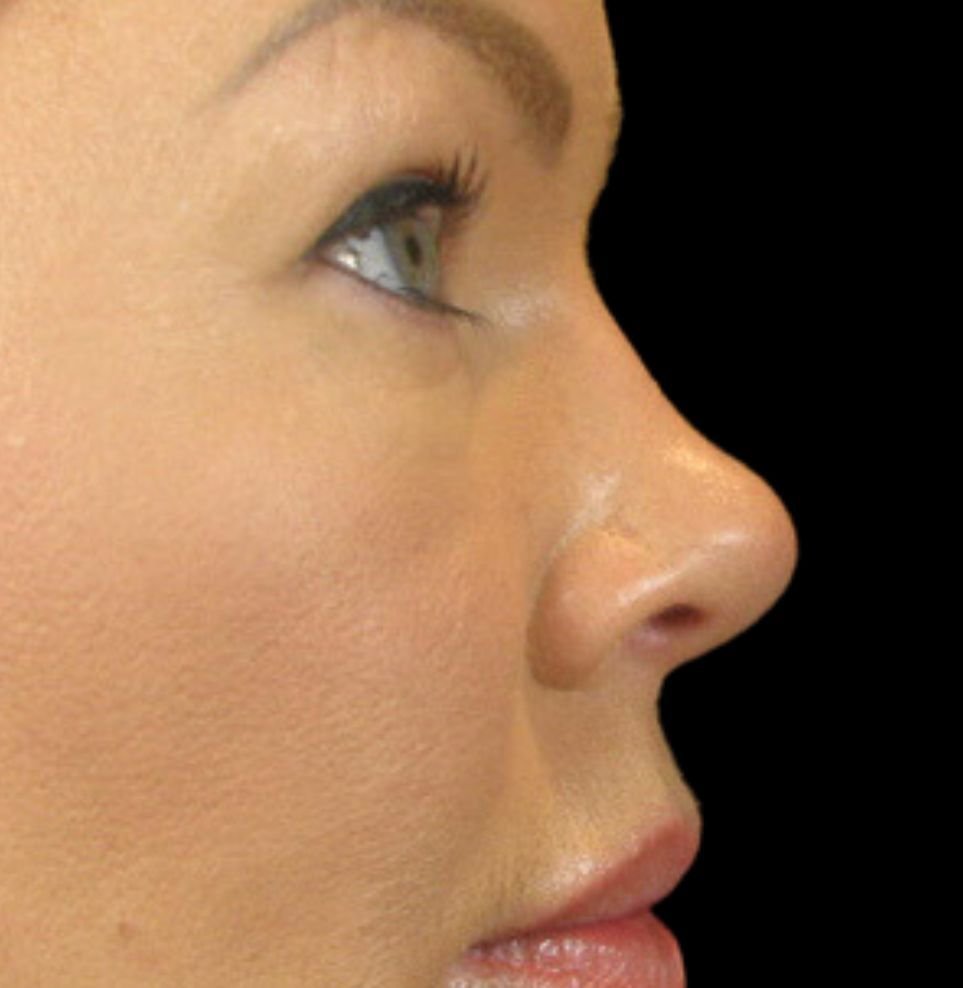nose filler treatment before