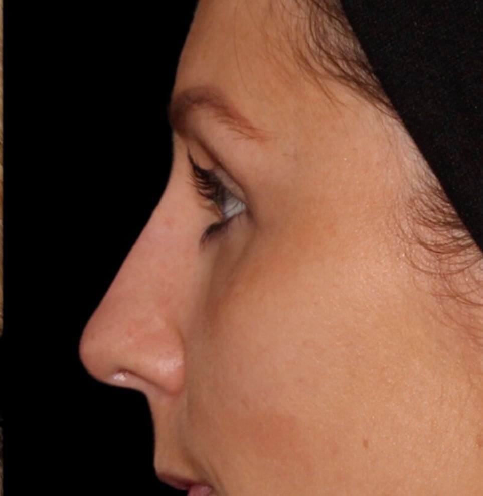 nose filler treatment after