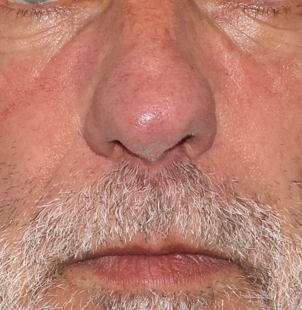 london redness treatment after
