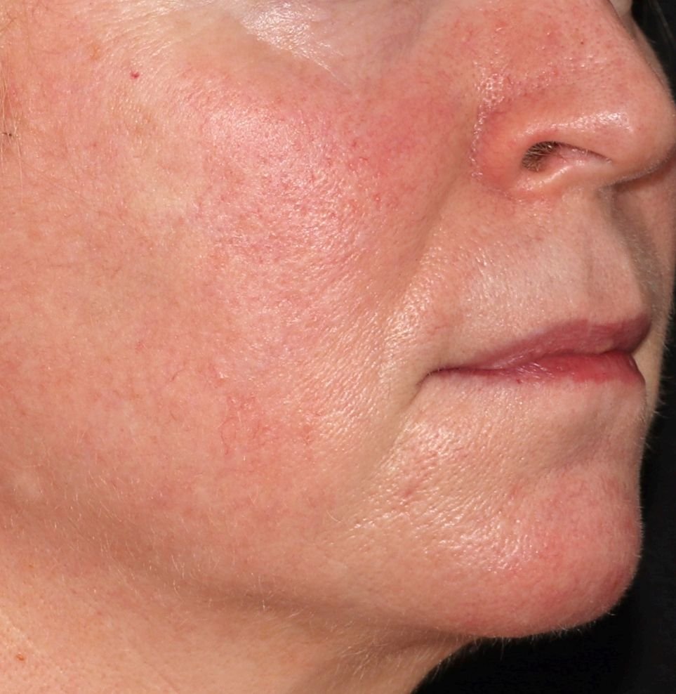 redness phi treatment after