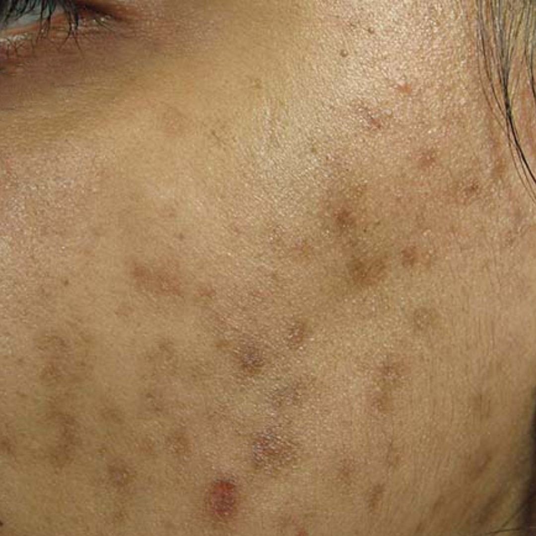 acne scar treatment before
