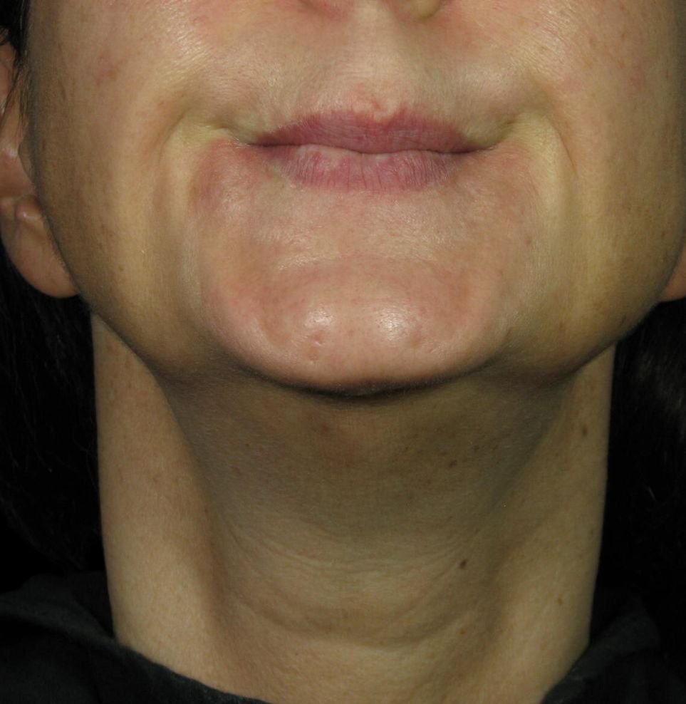 chin botox treatment after