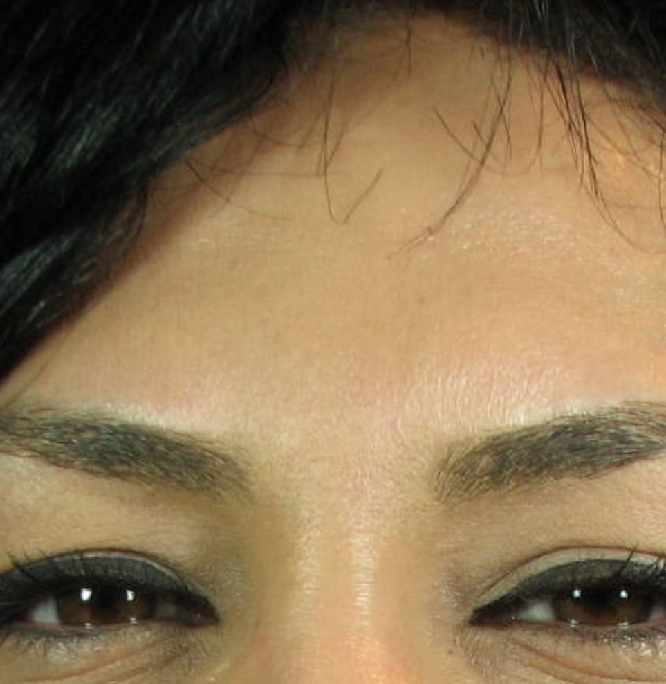 frown lines botox after