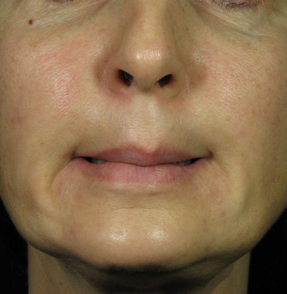 chin botox phi treatment after