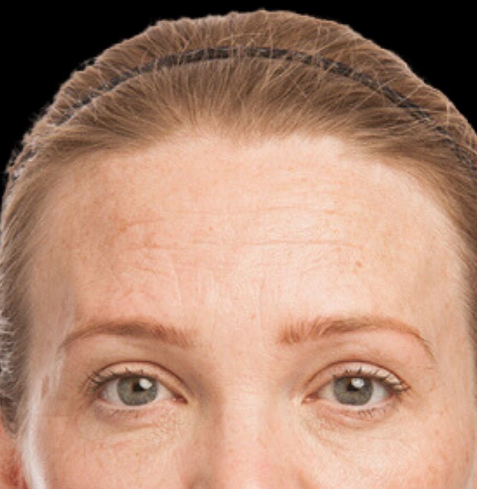 forehead lines botox treatment after