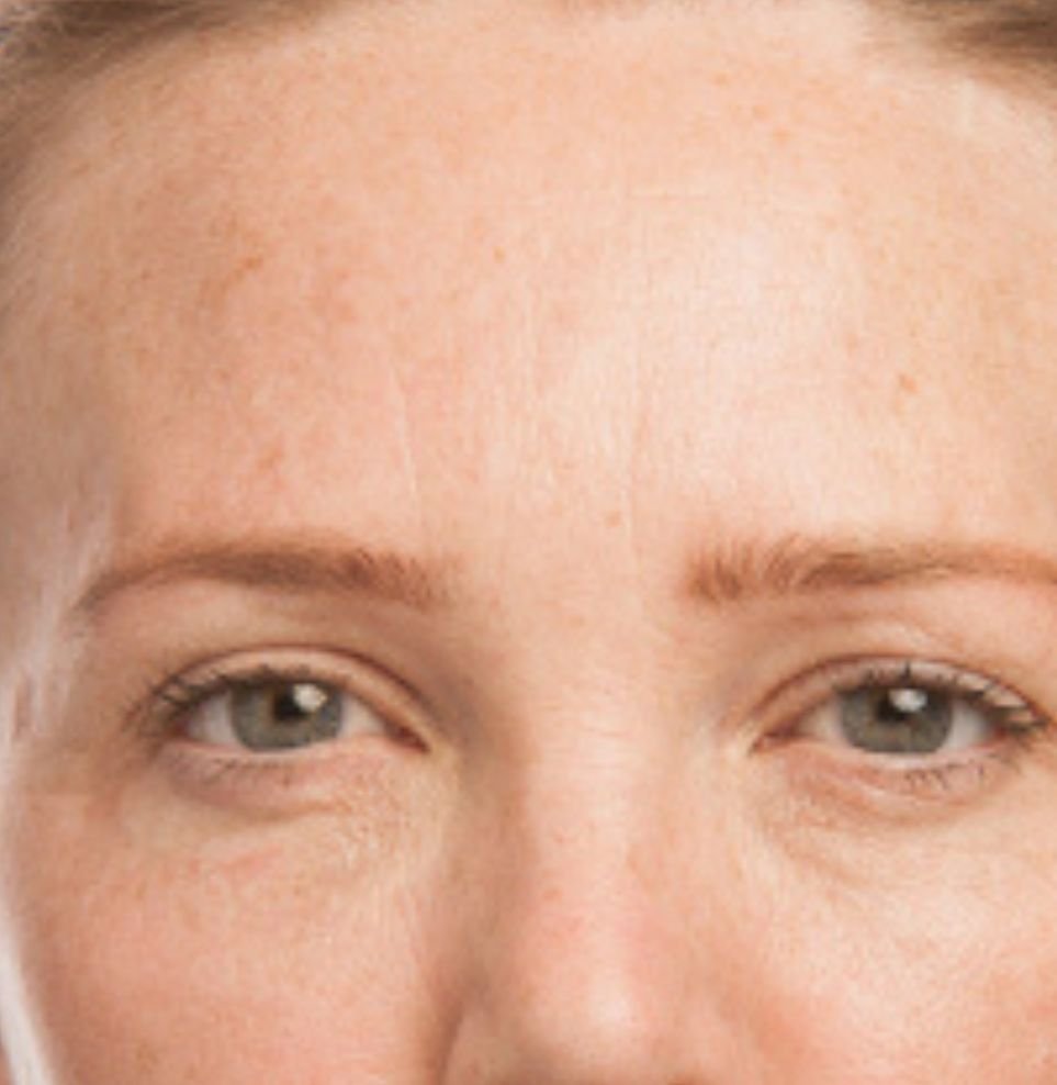 frown lines treatment after