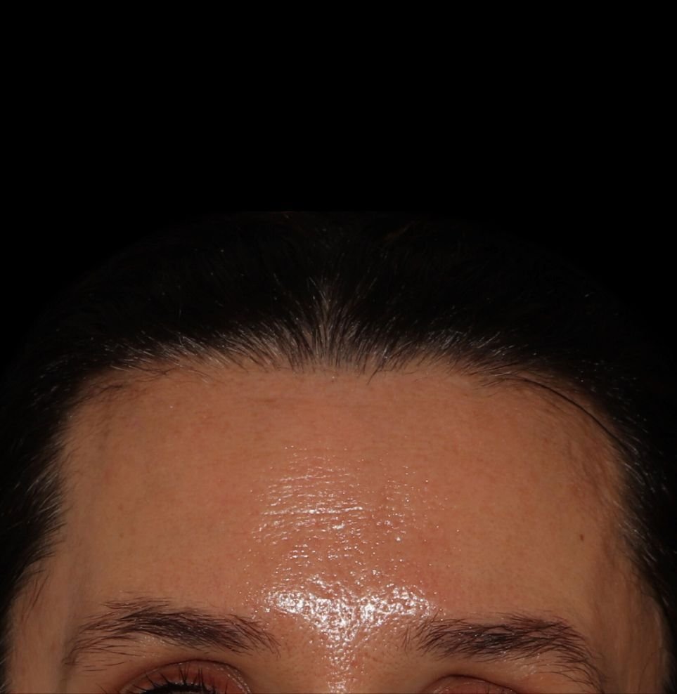 forehead lines botox after