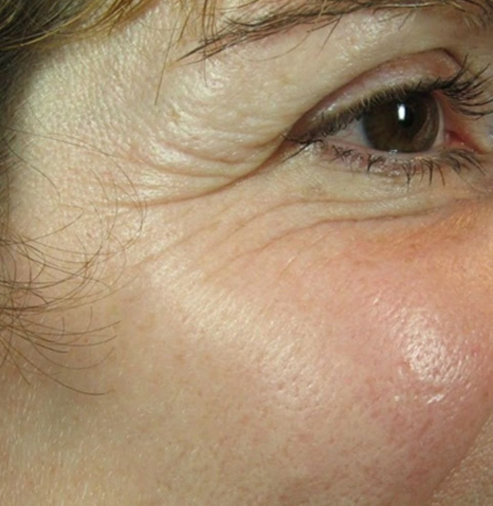 crows feet treatment botox after