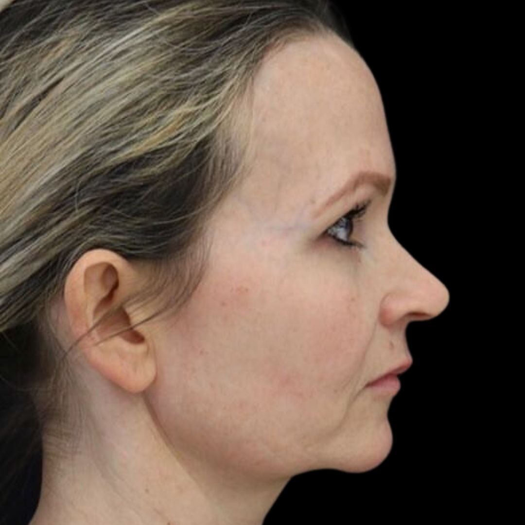 non-surgical facelift before