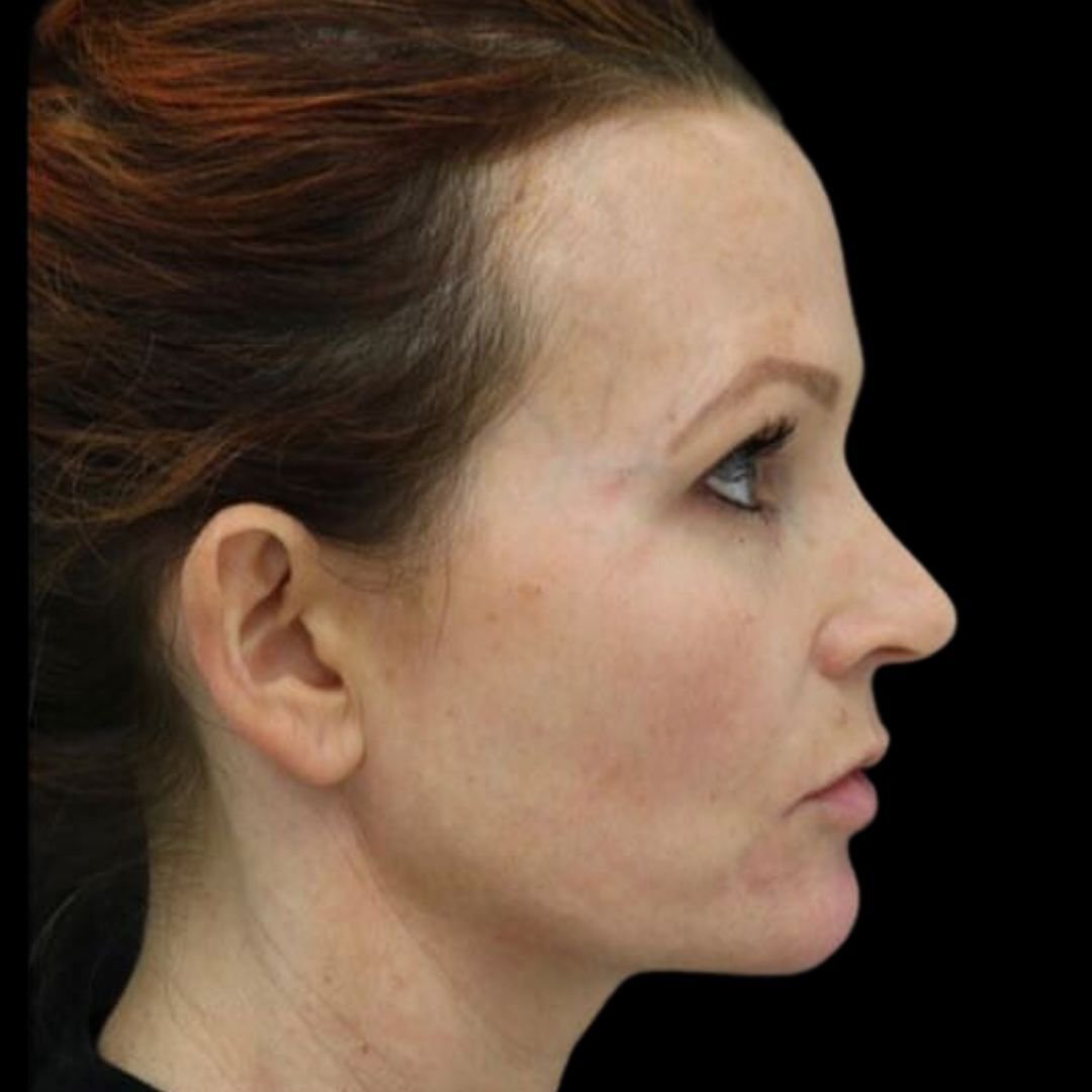 non-surgical facelift treatment result after