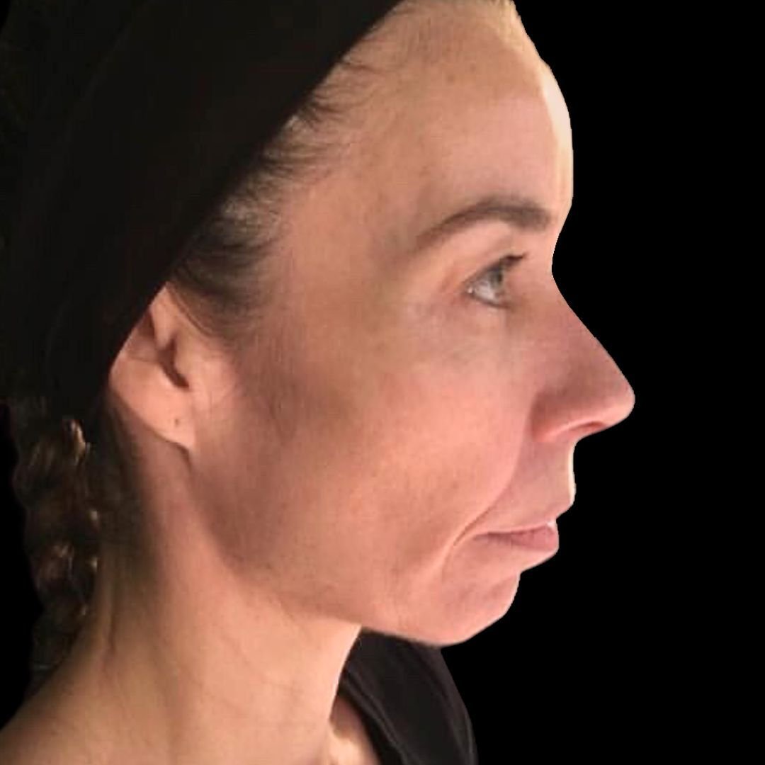jawline filler treatment before