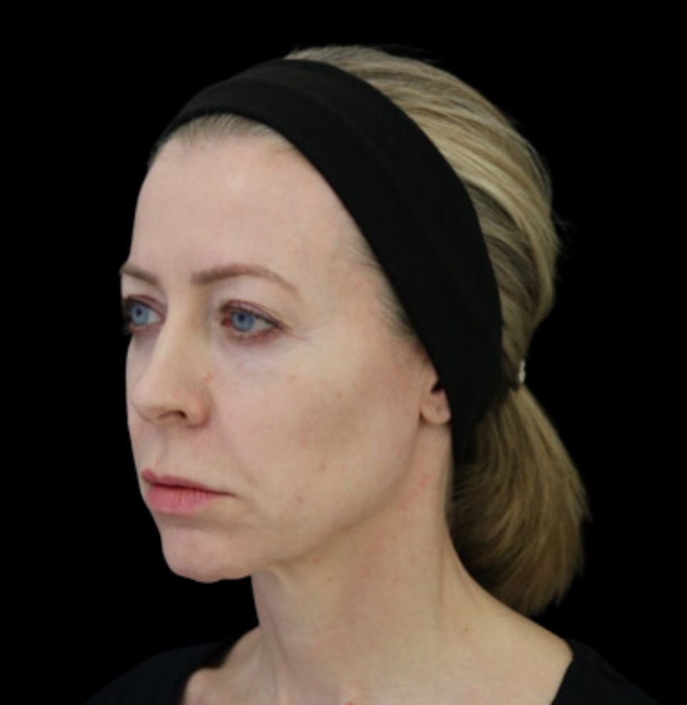 non-surgical facelift before