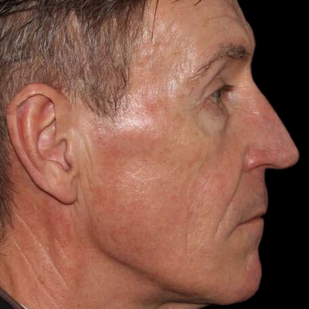 age spot pigmentation treatment after
