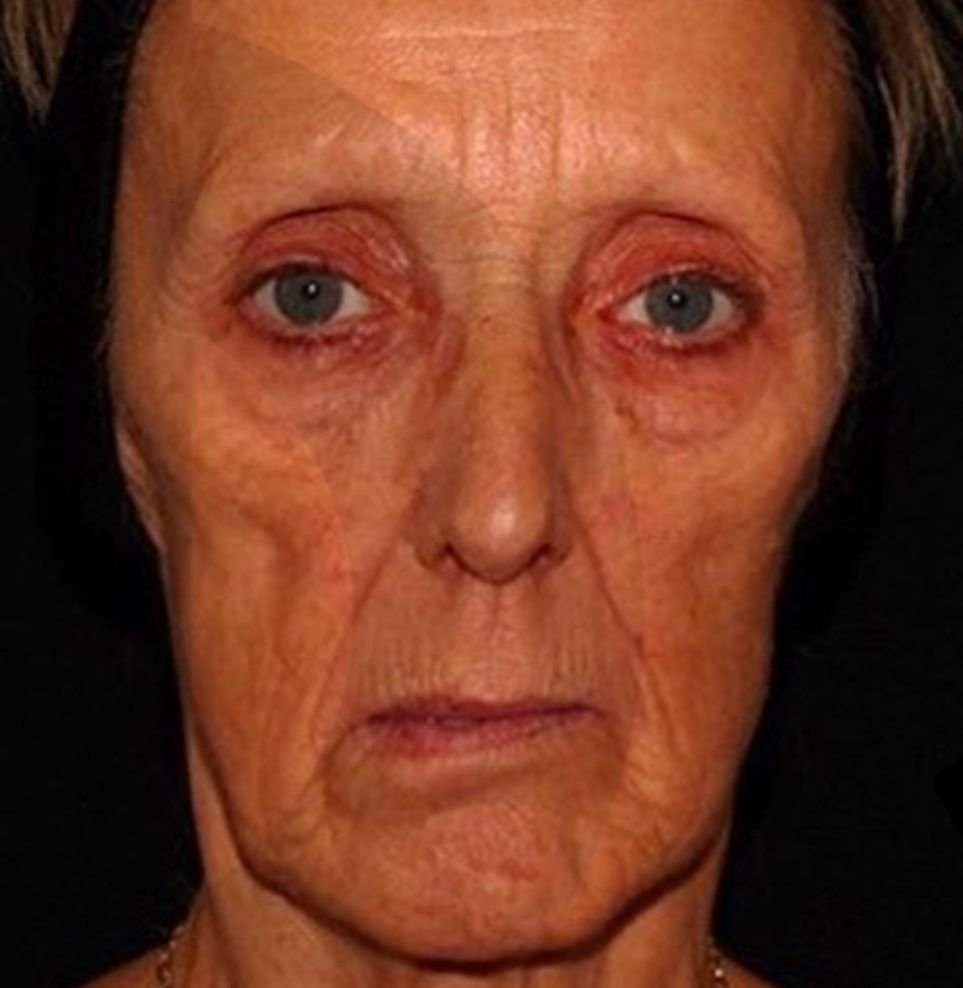non-surgical facelift before treatment