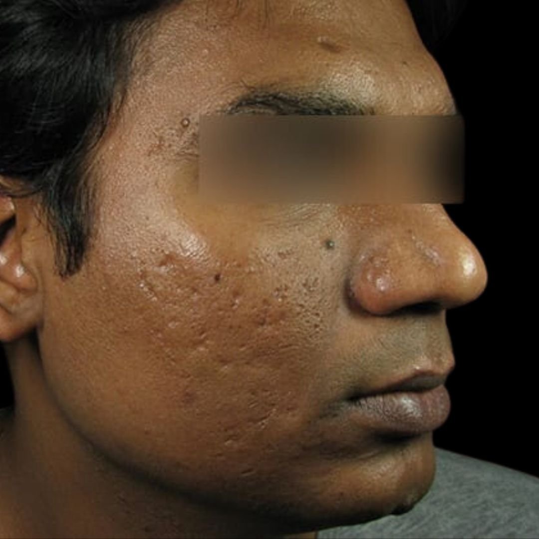 acne scar treatment london before