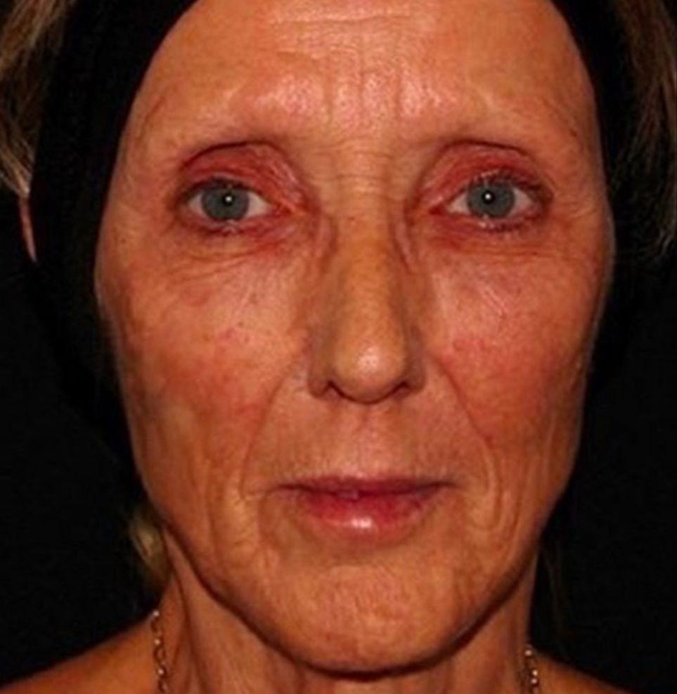 non-surgical facelift after treatment