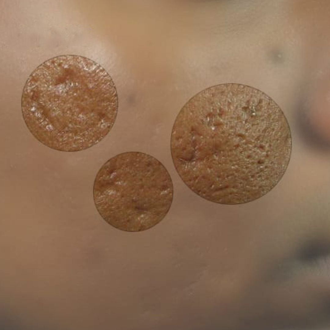 acne scar london treatment before