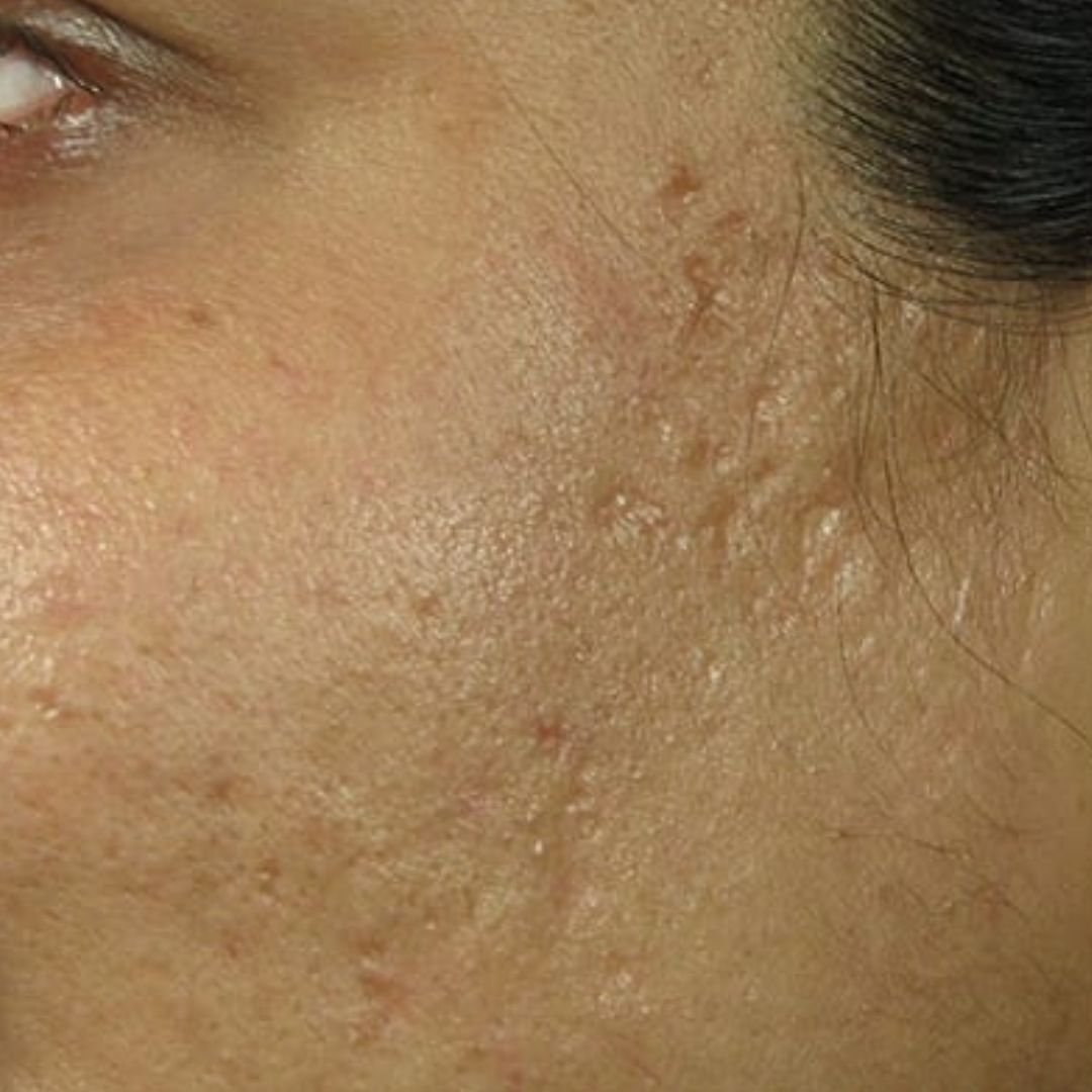 acne scar treatment london clinic  before