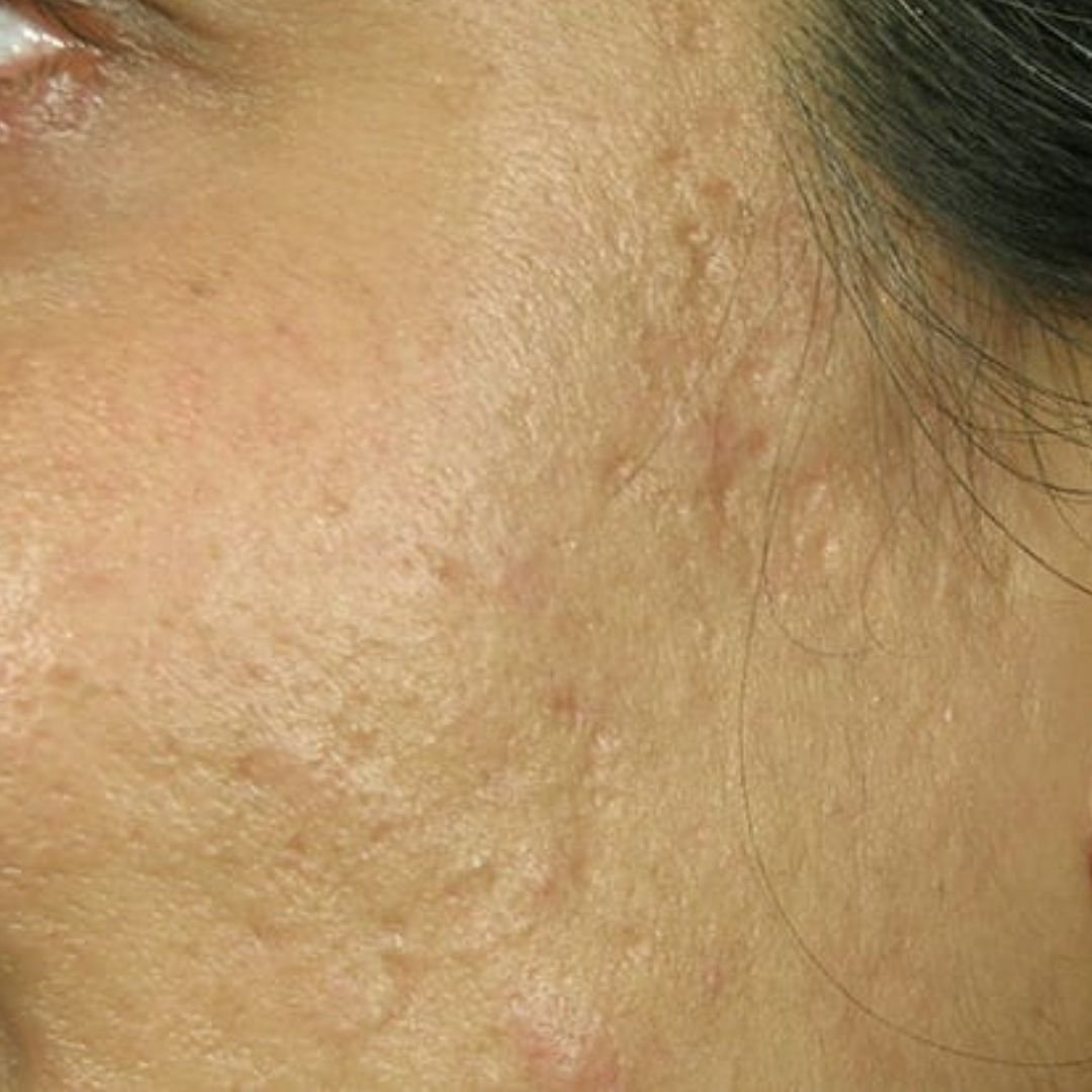 acne scar treatment london clinic after