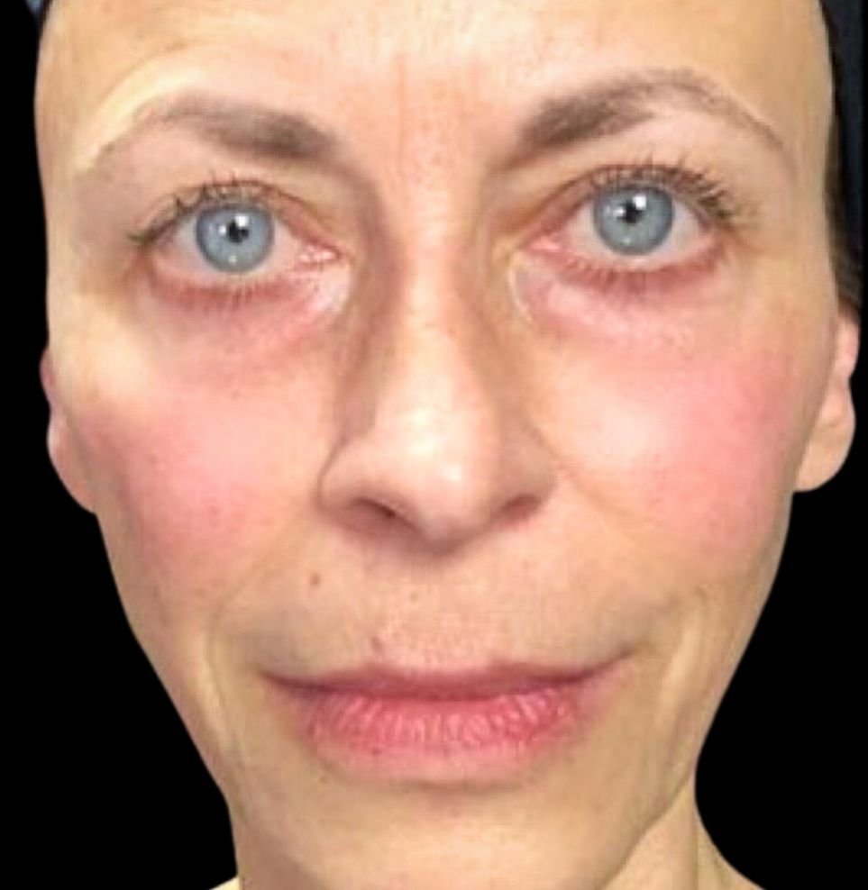 non-surgical facelift after