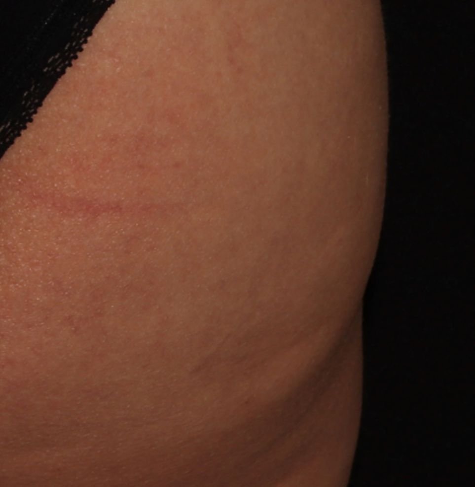cellulite buttocks endolift treatment after