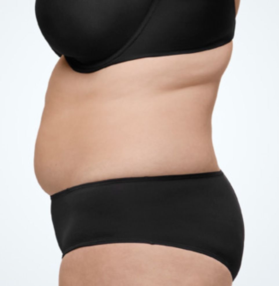 Coolsculpting belly fat reduction before after london