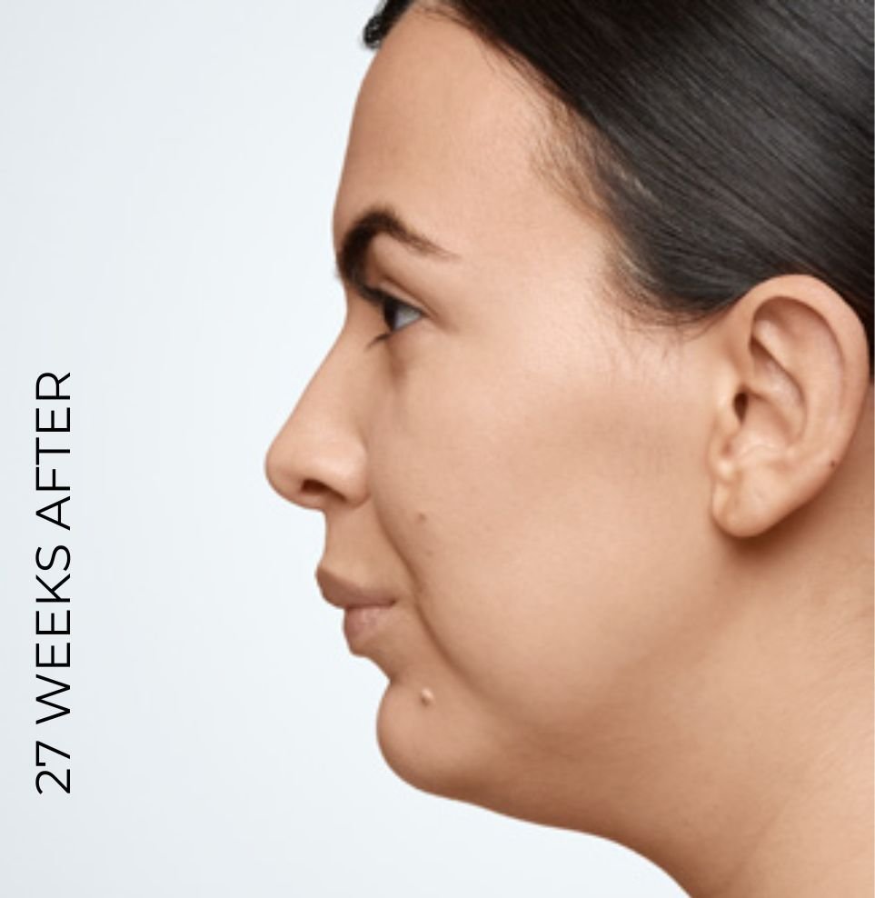 Coolsculpting jawline reduction before after london